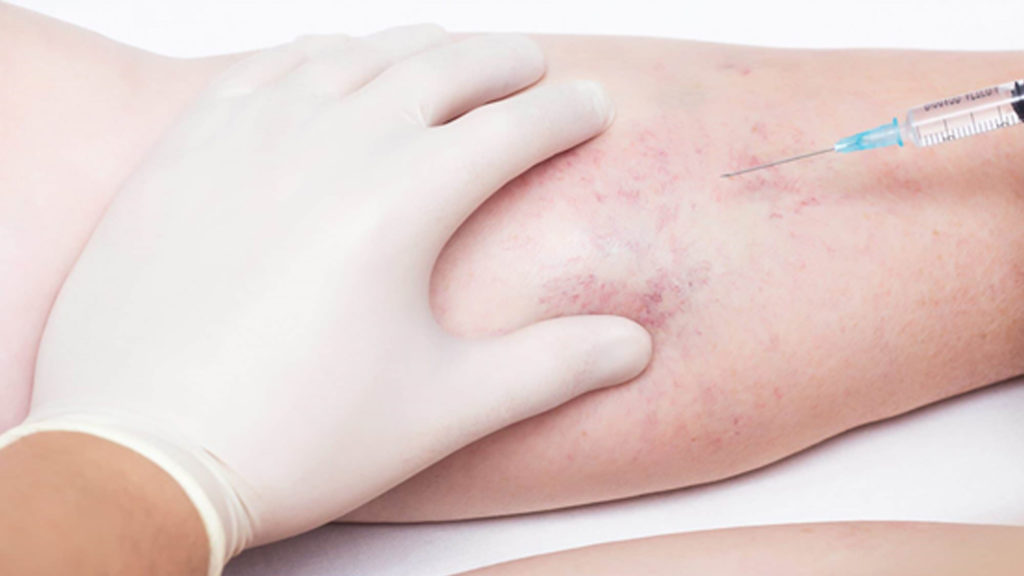 Microsclerotherapy